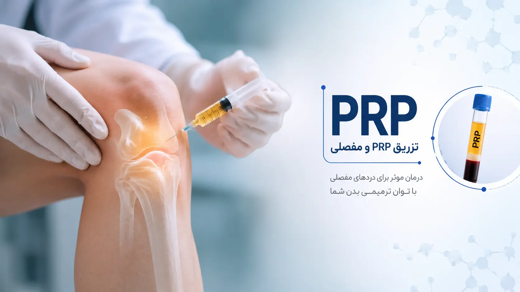 تزریق PRP و مفصلی در شهریار