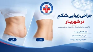 جراحی زیبایی شکم در شهریار درمانگاه کیمیا