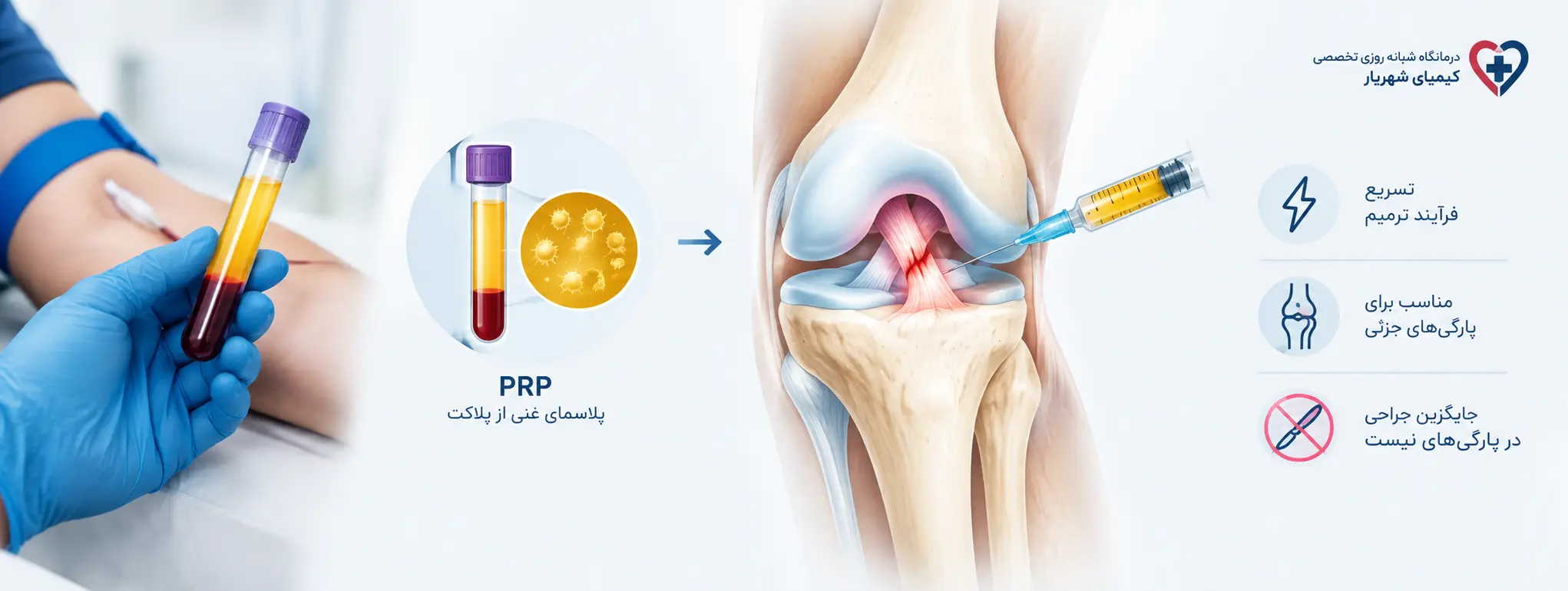 نقش PRP در درمان پارگی رباط صلیبی